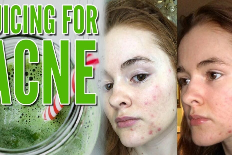 Tổng Hợp 97 Detox Juice For Acne Update