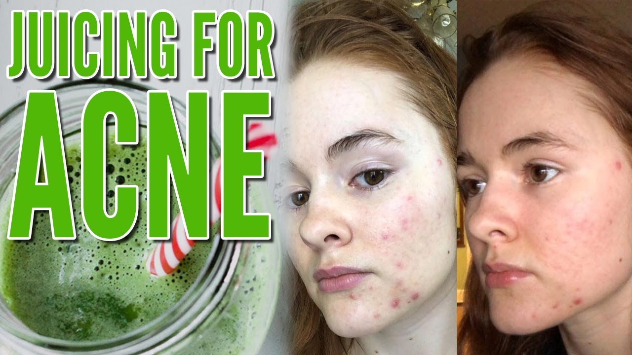 Juicing For Acne (How I Cleared My Acne In Four Days!) - Youtube