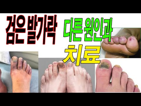 발톱 이 검은 색 – 원인, 증상, 대처법 및 전문가 조언