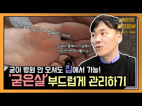 Meta 손가락 굳은 살 제거: 전문가 팁과 효과적인 방법