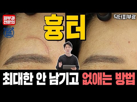 Top 83 얼굴 흉터 없애는 법 Update