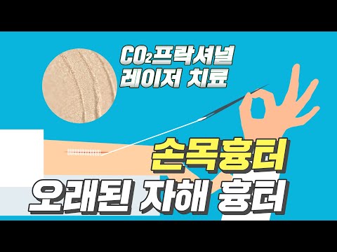 자해 흉터 제거 비용 – 최신 정보 및 비용 절감 전략